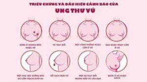 Bí quyết phòng ngừa bệnh ung thư vú